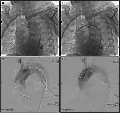Clinical outcomes and aortic remodeling after Castor single-branched stent-graft implantation for type B aortic dissections involving left subclavian artery